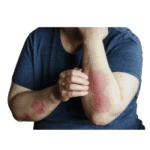 Psoriasis
